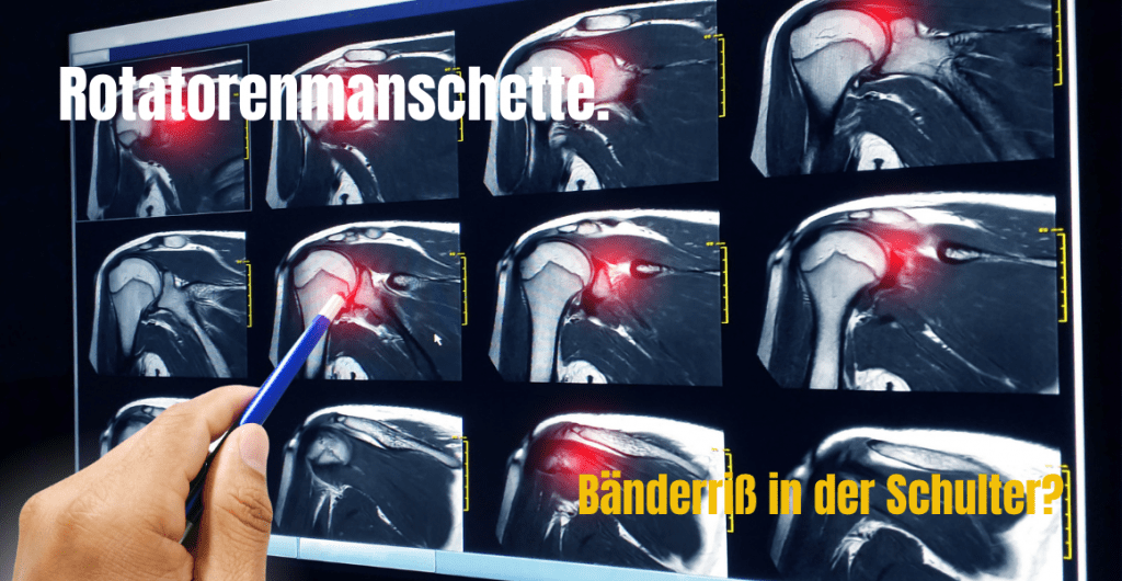 Rotatorenmanschettenruptur Bänderriss in der Schulter.